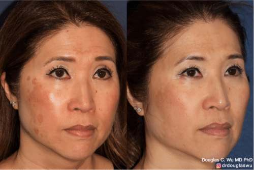 PicoClear for Melasma