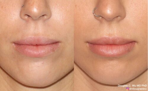 Natural lip volumization