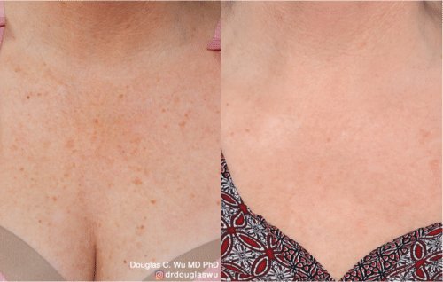 PicoWay rejuvenation of decolletage