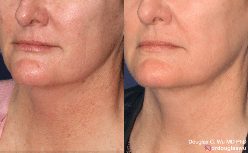 PicoWay Vbeam rejuvenation of the neck
