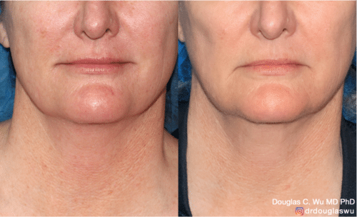 PicoWay Vbeam rejuvenation of the neck