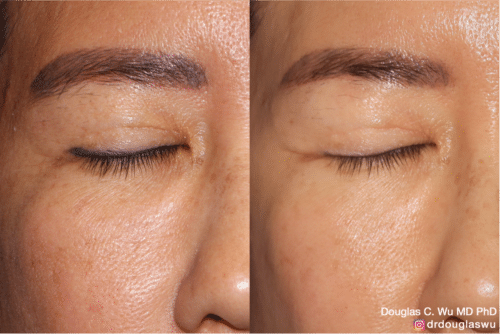 Eyeliner tattoo removal