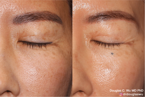 Eyeliner tattoo removal