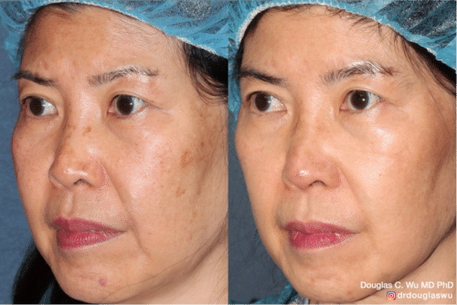 PicoUltra laser resurfacing to improve skin tone