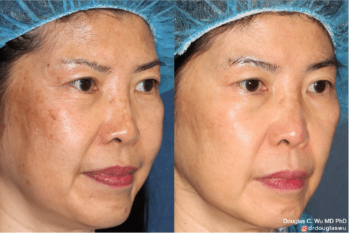 PicoUltra laser resurfacing to improve skin tone