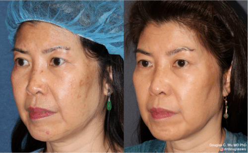 PicoUltra laser resurfacing to improve skin tone