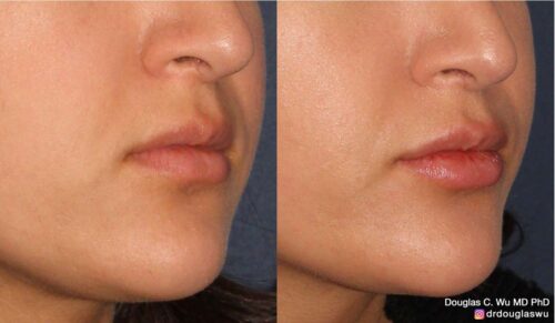 Natural lip volumization