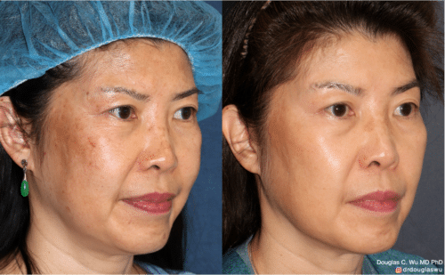 PicoUltra laser resurfacing to improve skin tone
