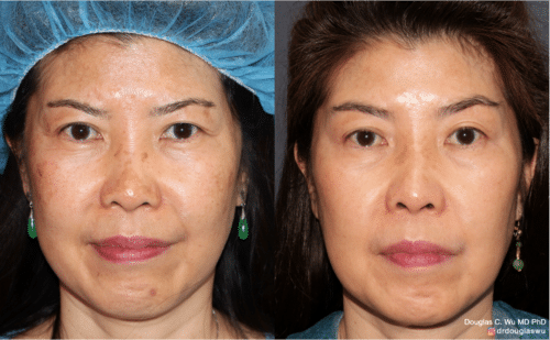 PicoUltra laser resurfacing to improve skin tone