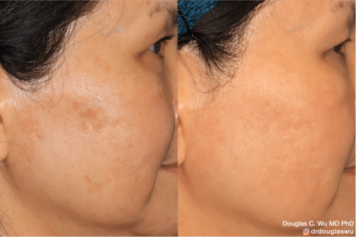 PicoSpot removal