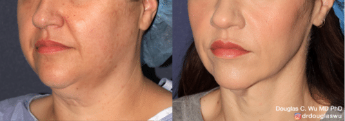 ThermiSculpt to tighten and refine the neck and jawline