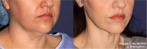 ThermiSculpt to tighten and refine the neck and jawline
