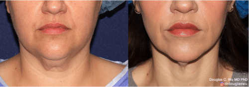 ThermiSculpt to tighten and refine the neck and jawline