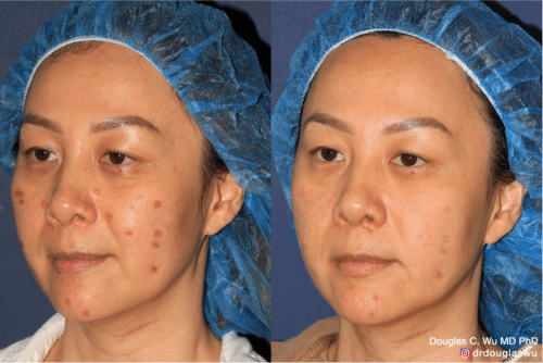 Treatment of laser injury