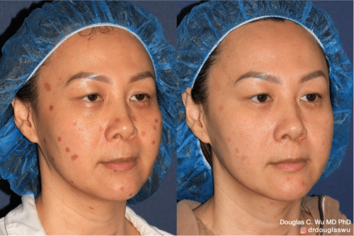 Treatment of laser injury