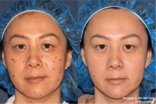 Treatment of laser injury