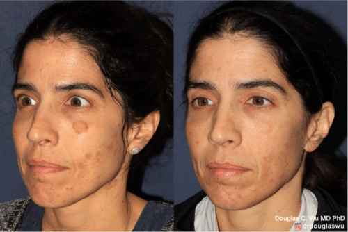 PicoUltra laser resurfacing to improve skin tone
