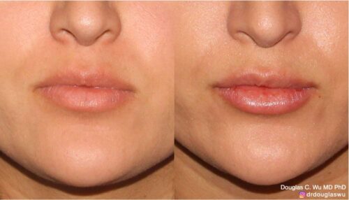 Natural lip volumization