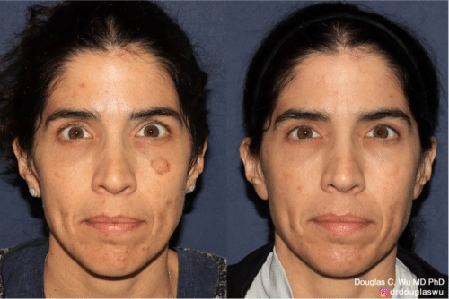 PicoUltra laser resurfacing to improve skin tone