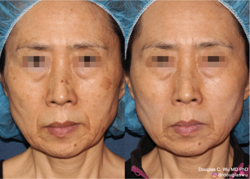 PicoUltra laser resurfacing to improve skin tone