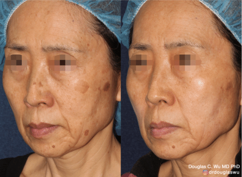 PicoUltra laser resurfacing to improve skin tone