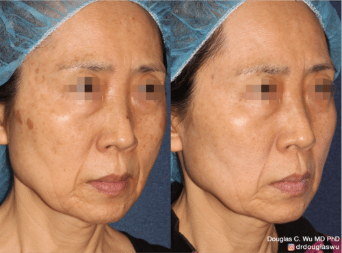 PicoUltra laser resurfacing to improve skin tone