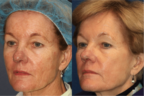 Photodynamic therapy laser resurfacing