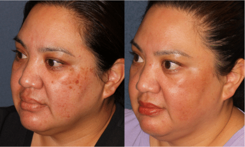 PicoUltra laser resurfacing to improve skin tone