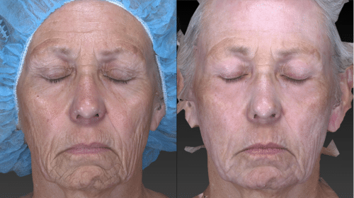 Laser resurfacing to tighten the skin, remove wrinkling and fine lines that give a dull tired appearance