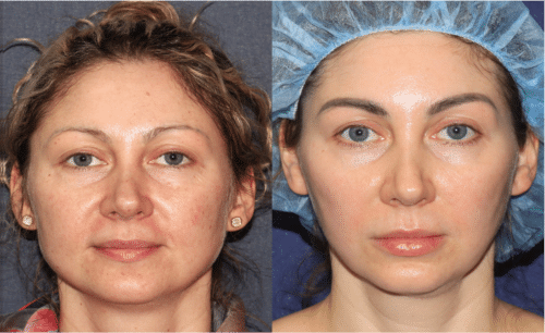 Multimodal combination treatment with Pico laser, Vbeam, Frax, Filler and Botox