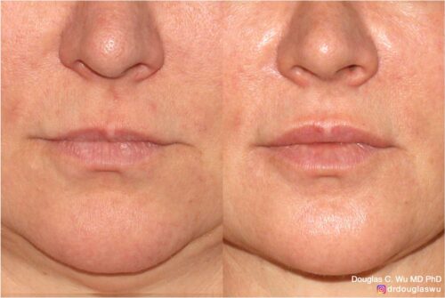 Natural lip volumization