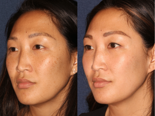 PicoClear for brightening skin tone and spot removal