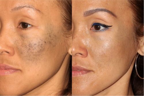 PicoWay birthmark removal