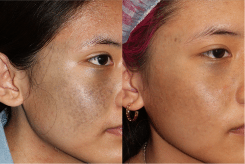 PicoWay birthmark removal