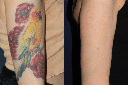 PicoWay tattoo removal