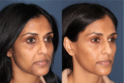 PicoUltra laser resurfacing to improve skin tone