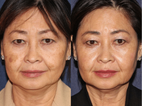 PicoUltra laser resurfacing to improve skin tone