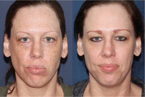PicoUltra laser resurfacing to improve skin tone