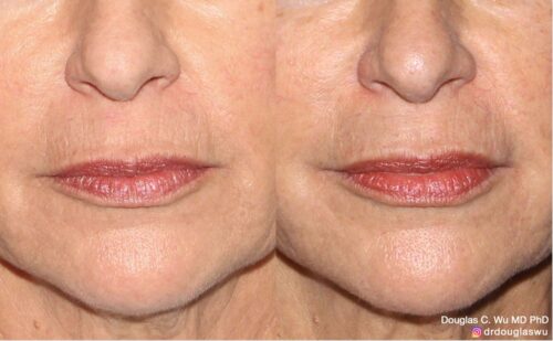 Natural lip volumization