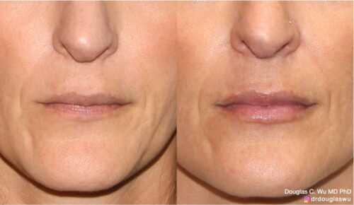 Natural lip volumization