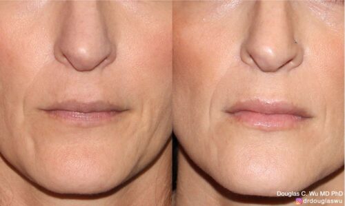 Natural lip volumization