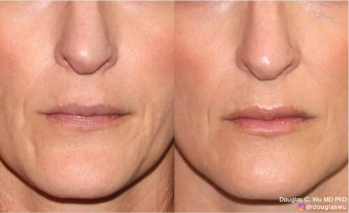 Natural lip volumization