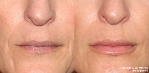 Natural lip volumization
