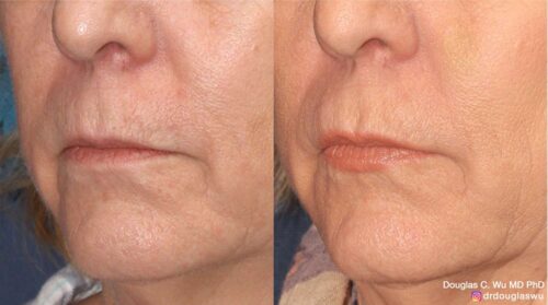 Natural lip volumization