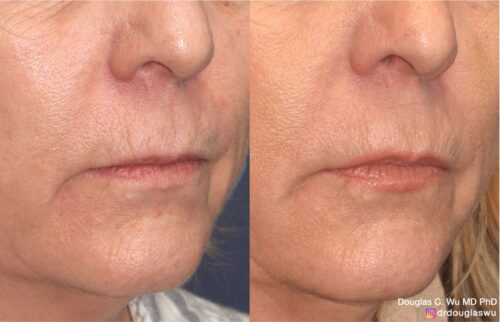 Natural lip volumization