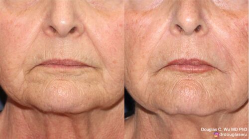 Softening of folds and wrinkles to lips and around mouth with filler