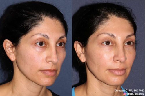 Facial harmonization with filler + BTX