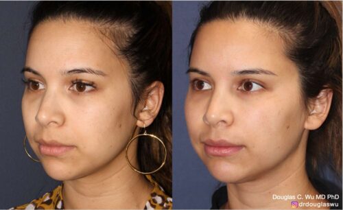 Facial harmonization with filler + BTX