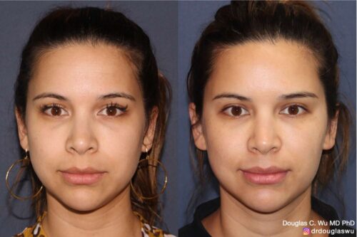 Facial harmonization with filler + BTX