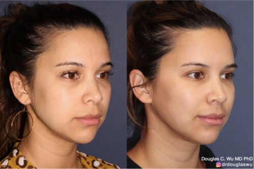 Facial harmonization with filler + BTX